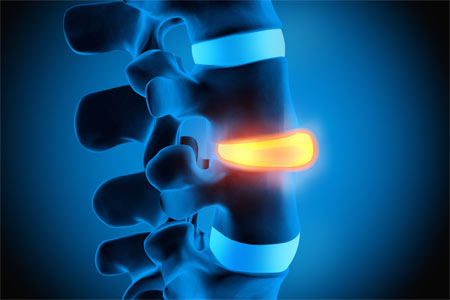 identificazione degli spazi intervertebrali