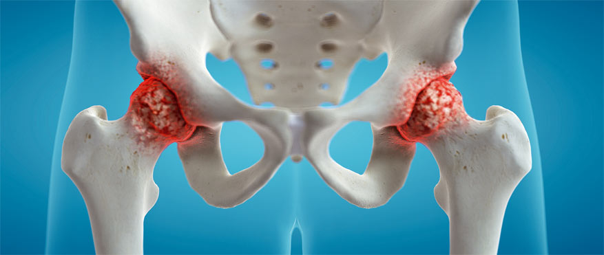 controllo osteoporosi a mestre con bioimpedenziometria